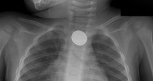 Extraen médicos monedas, uvas y figuritas de plástico del estomago de los niños