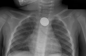 Extraen médicos monedas, uvas y figuritas de plástico del estomago de los niños