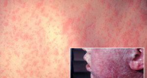 Descartan alerta por casos de sarampión en México