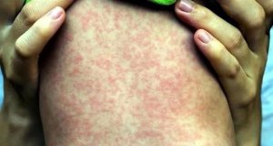 Hay 20 casos de sarampión de alto riesgo en la CDMX