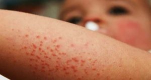 La Sana Distancia también puede evitar el sarampión