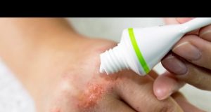 Temporada de lluvias trae enfermedades de la piel, sobre todo en niños