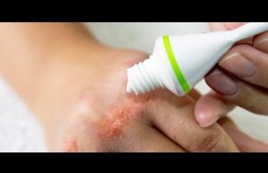 Temporada de lluvias trae enfermedades de la piel, sobre todo en niños