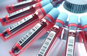 PanSeer, la prueba de sangre que detecta el cáncer 4 años antes de que se manifieste