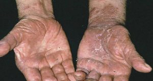 Prevalece en Sinaloa el problema de la lepra