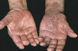 Prevalece en Sinaloa el problema de la lepra