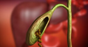 ¿Qué son los cálculos biliares y cómo se eliminan?