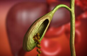 ¿Qué son los cálculos biliares y cómo se eliminan?