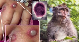 Viruela del mono… Aquí te decimos de qué se trata