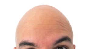 Adiós calvicie… Llega la tableta para tratar calvicie areata