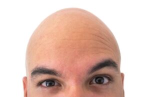 Adiós calvicie… Llega la tableta para tratar calvicie areata