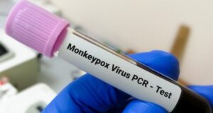 Confirman cinco casos de viruela símica en Jalisco