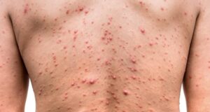 Sinaloa refuerza medidas sanitarias ante segundo brote de viruela símica