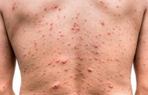 Sinaloa refuerza medidas sanitarias ante segundo brote de viruela símica