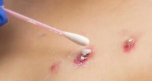 Viruela del mono: cuáles son sus síntomas y cómo prevenirla