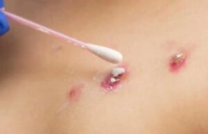 Viruela del mono: cuáles son sus síntomas y cómo prevenirla