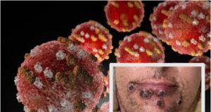 Llaman a reforzar medidas de prevención contra la “Viruela Símica”