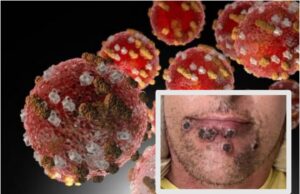 Llaman a reforzar medidas de prevención contra la “Viruela Símica”