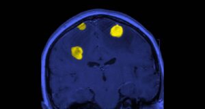 Dan esperanza a pacientes con tumores cerebrales