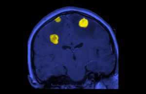 Dan esperanza a pacientes con tumores cerebrales