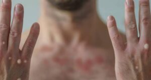 Detecta SSa un nuevo paciente sospechoso de viruela del mono en Mazatlán