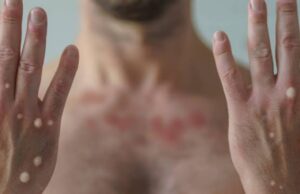 Detecta SSa un nuevo paciente sospechoso de viruela del mono en Mazatlán