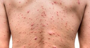 Sector Salud confirma caso positivo a Viruela del Mono