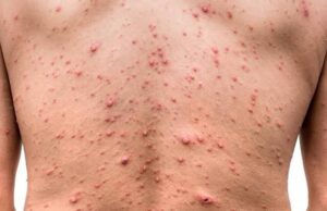 Sector Salud confirma caso positivo a Viruela del Mono