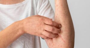 Se mantiene Sinaloa sin casos de Viruela del Mono