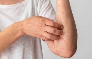 Se mantiene Sinaloa sin casos de Viruela del Mono