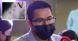 Sector salud detecta nuevo caso sospechoso de Viruela Símica en Culiacán