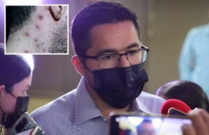 Sector salud detecta nuevo caso sospechoso de Viruela Símica en Culiacán
