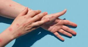 Detectan nuevo sospechoso de Viruela del Mono en Sinaloa