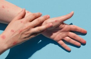 Detectan nuevo sospechoso de Viruela del Mono en Sinaloa