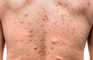 Confirma Salud tres nuevos casos positivos de viruela del mono