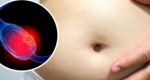 Cáncer de ovario: segunda causa de muerte en México