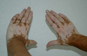 Es necesario sensibilizar a la población sobre lo que en realidad es el vitíligo