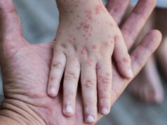 Llaman a la población a no alarmarse por aumento de casos de coxsackie