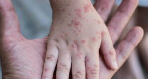 Llaman a la población a no alarmarse por aumento de casos de coxsackie