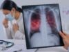 La tuberculosis es curable si se detecta y trata oportunamente